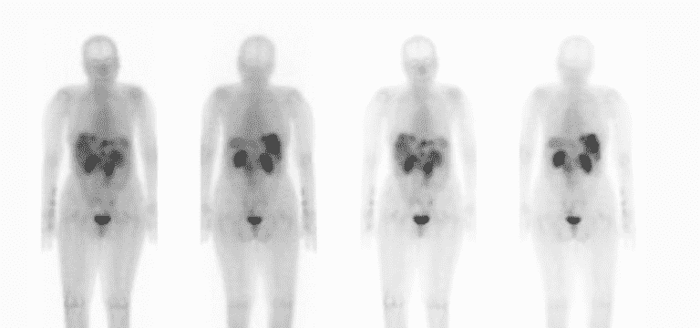 A Complete Guide for Octreotide Scan (DOTA-Scan) and How It Differs From Pet Scan